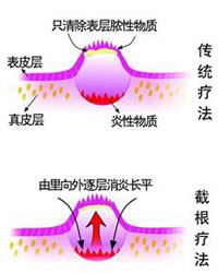 激光祛痘的注意事项